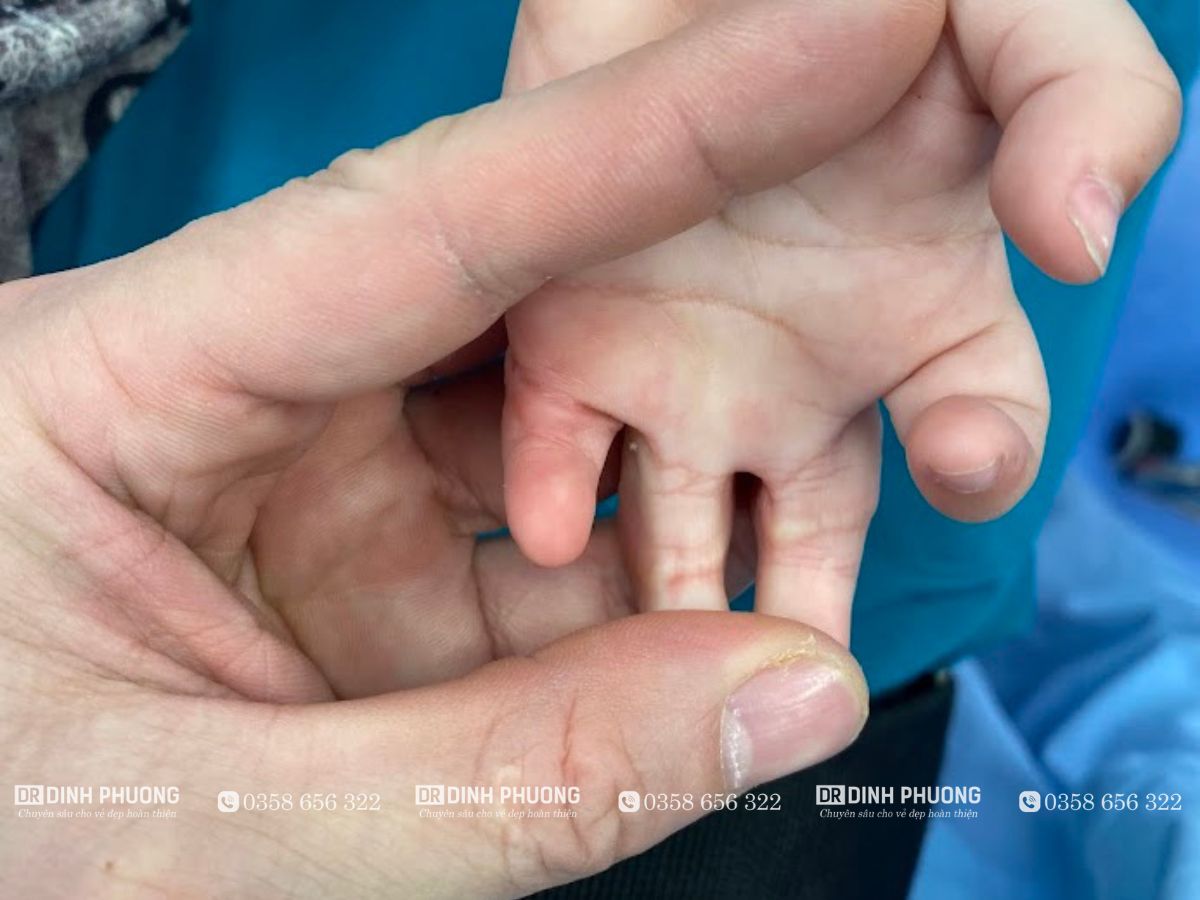 Các nguyên nhân thường gặp gây nên sẹo co kéo ngón tay