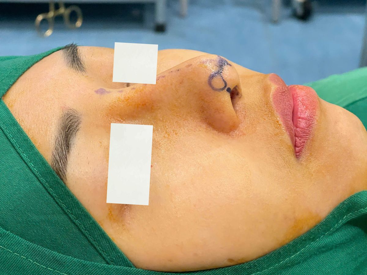 Các vấn đề hay được quan tâm khi sửa mũi hỏng