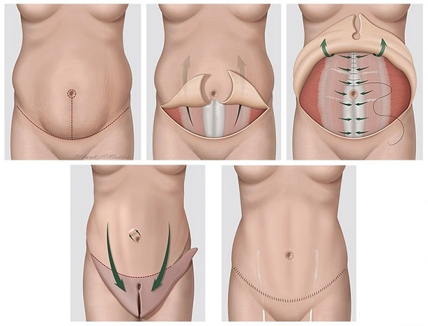 Tái cấu trúc thành bụng toàn phần