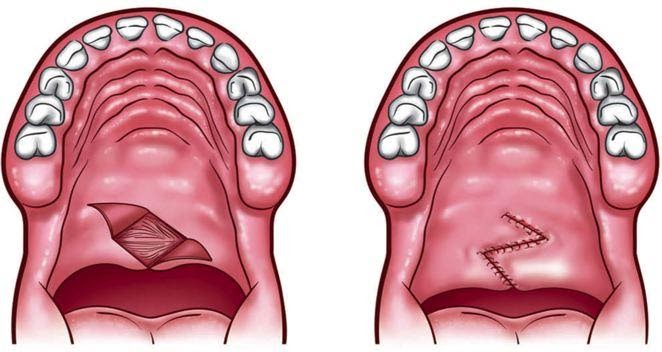 Kỹ thuật tái tạo vòm mềm