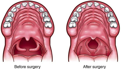 Kỹ thuật Sphincter pharyngoplasty trong điều trị thiểu sản vòm hầu