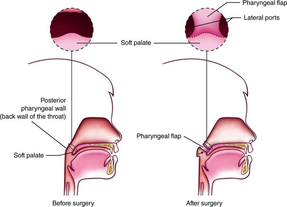Kỹ thuật tái cấu trúc vòm hầu bằng vạt mô phía sau họng