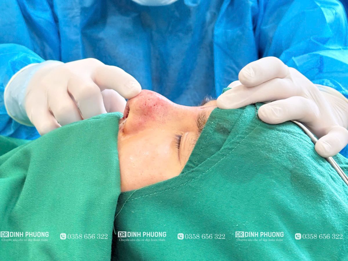 Tạo hình thẩm mỹ mũi được tiến hành như thế nào?