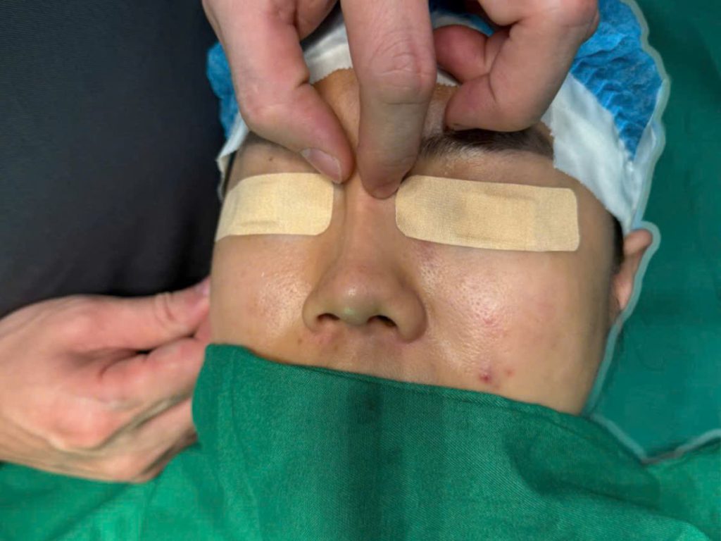 Chỉnh sửa mũi gặp biến chứng sau nâng mũi