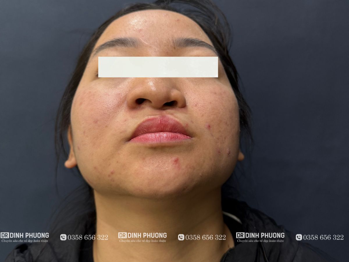 Tại sao nên thực hiện tạo hình thẩm mỹ mũi khi đã trưởng thành?