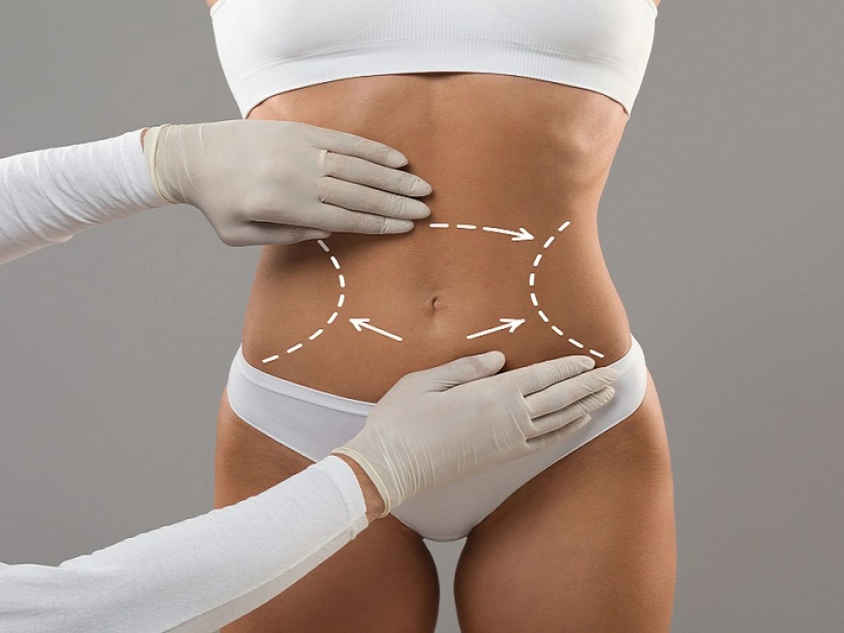 Tái tạo thành bụng mang lại vóc dáng gọn gàng, cân đối