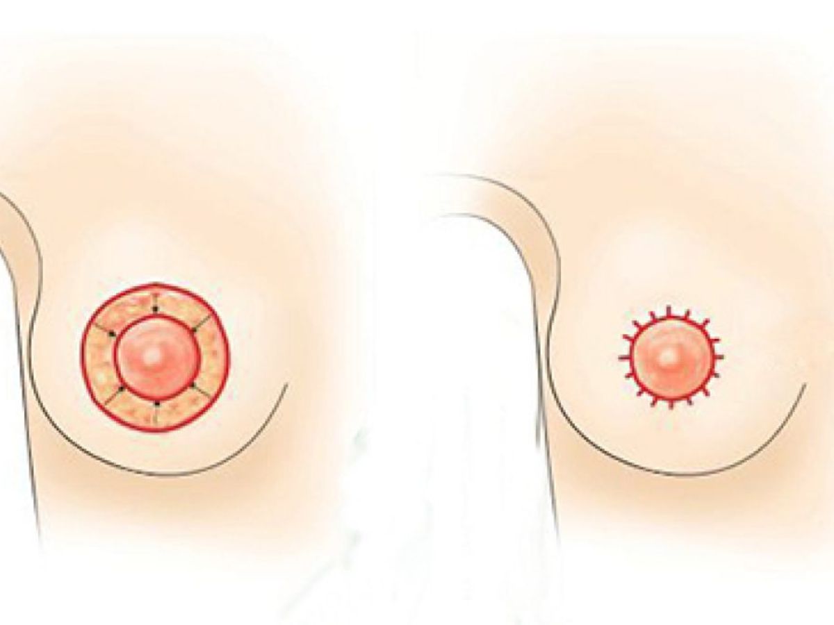 Tạo hình và thu gọn quầng ti