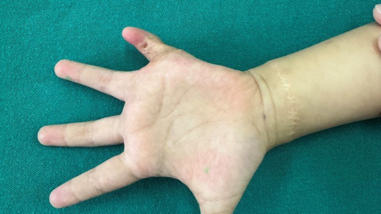 Điều trị sẹo co kéo ngón tay