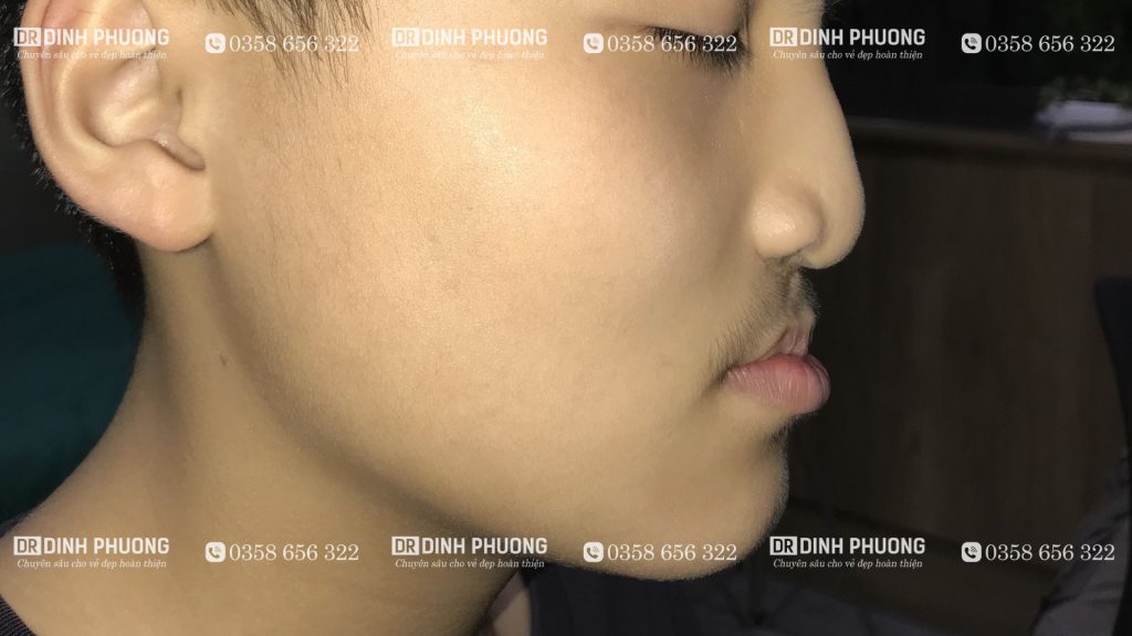 Hình ảnh bệnh nhân thiểu sản xương hàm trên