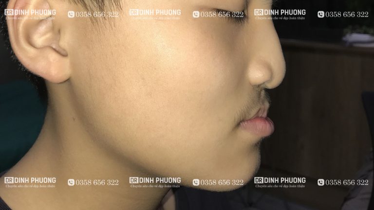 Hình ảnh bệnh nhân thiểu sản xương hàm trên