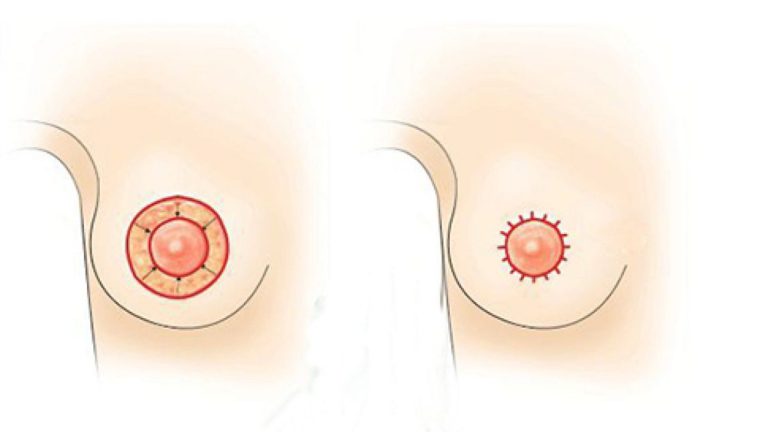 thu gọn quầng ti