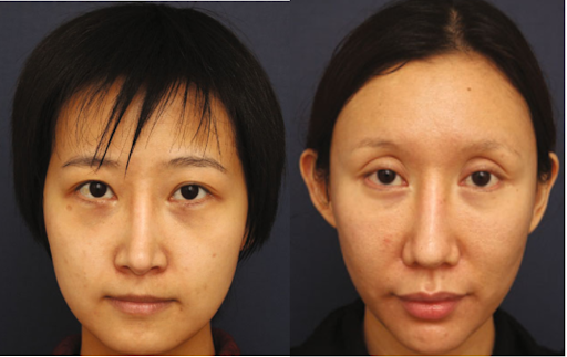 Vật liệu mũi nhìn lộ dưới da