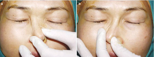 Vật liệu nâng mũi di động và di lệch 