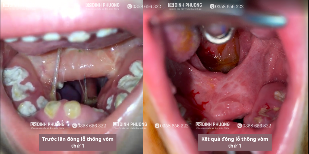 Lỗ thông vòm trước và sau lần phẫu thuật đầu tiên