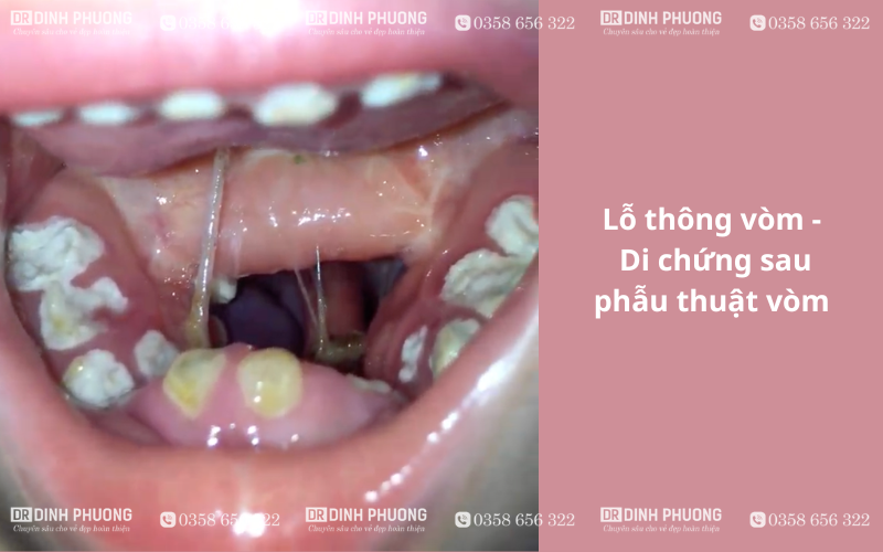 Lỗ thông vòm lớn