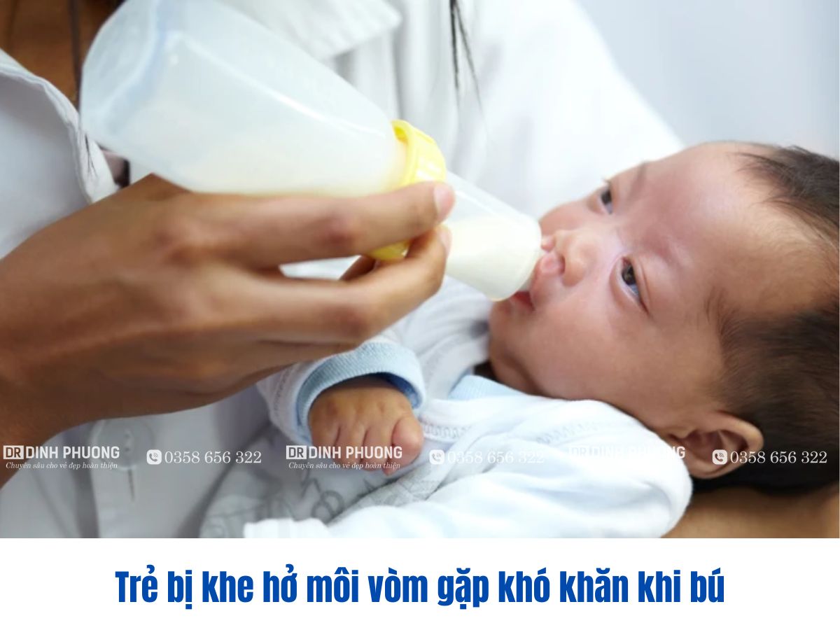 Trẻ bị khe hở môi vòm gặp khó khăn khi bú
